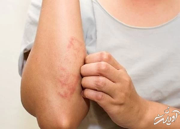 کهیر بر اثر آفتاب کهیر